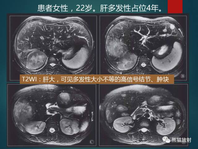 【PPT】肝糖原累积症(弥漫性肝实质密度增高病变的鉴别诊断)