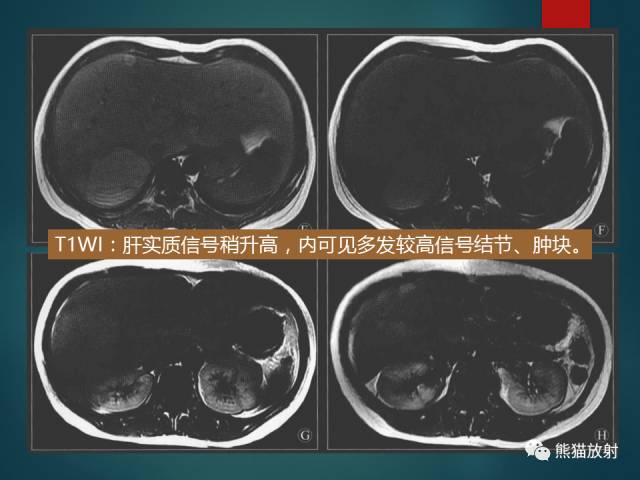 【PPT】肝糖原累积症(弥漫性肝实质密度增高病变的鉴别诊断)