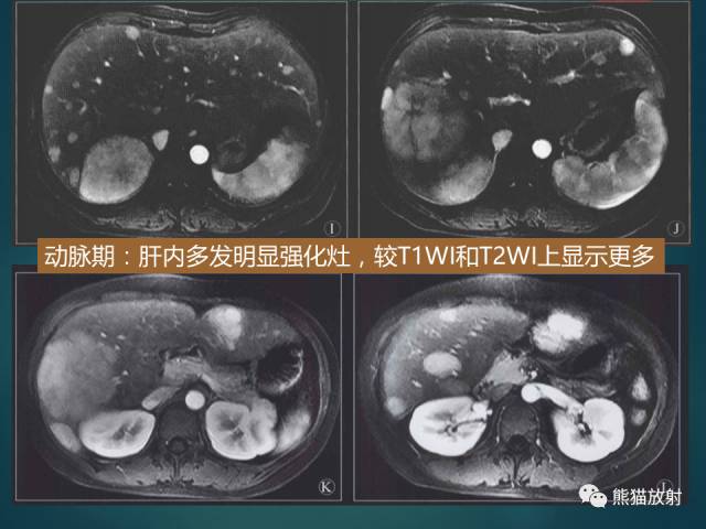 【PPT】肝糖原累积症(弥漫性肝实质密度增高病变的鉴别诊断)