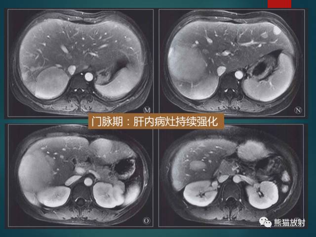 【PPT】肝糖原累积症(弥漫性肝实质密度增高病变的鉴别诊断)