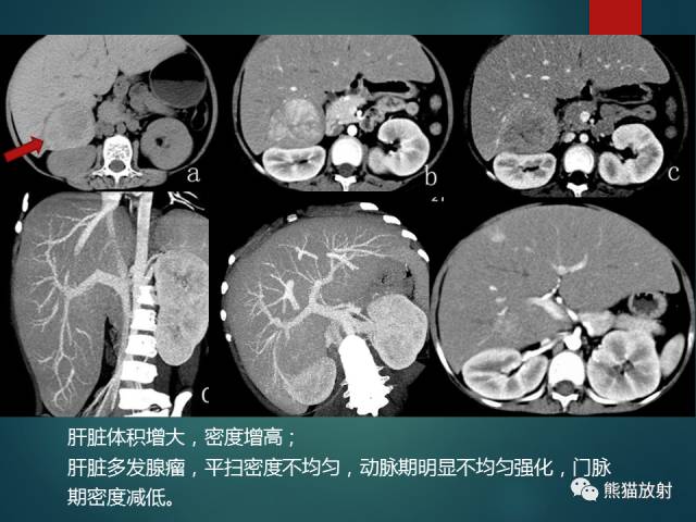 【PPT】肝糖原累积症(弥漫性肝实质密度增高病变的鉴别诊断)