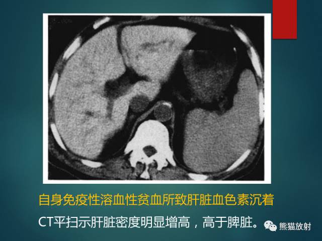 【PPT】肝糖原累积症(弥漫性肝实质密度增高病变的鉴别诊断)