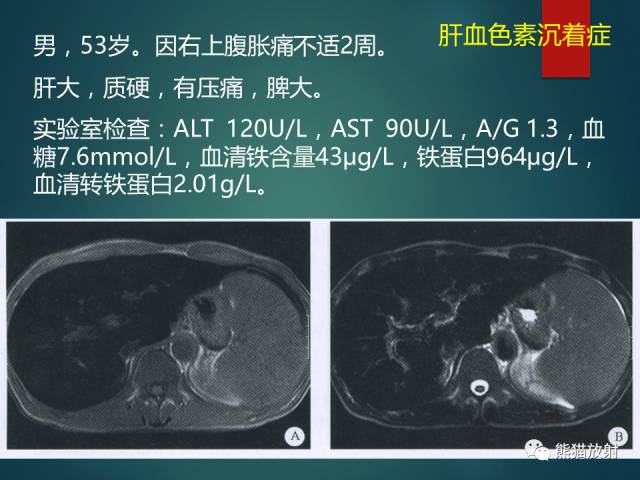 【PPT】肝糖原累积症(弥漫性肝实质密度增高病变的鉴别诊断)