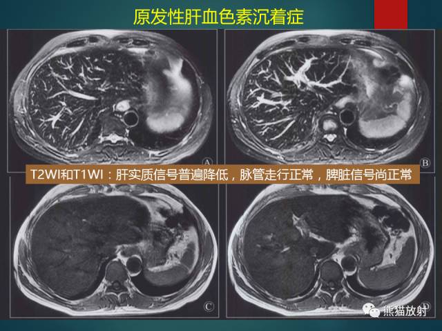 【PPT】肝糖原累积症(弥漫性肝实质密度增高病变的鉴别诊断)