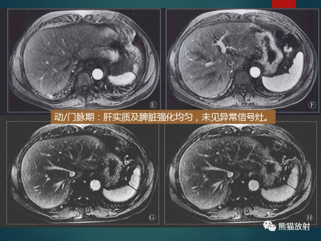 【PPT】肝糖原累积症(弥漫性肝实质密度增高病变的鉴别诊断)