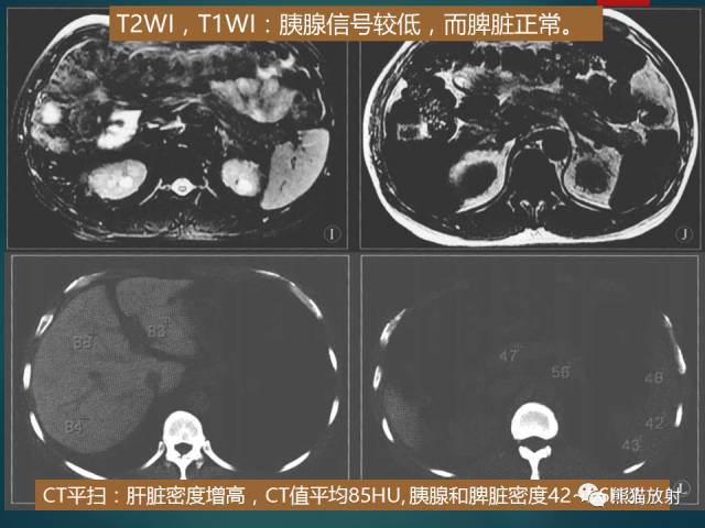 【PPT】肝糖原累积症(弥漫性肝实质密度增高病变的鉴别诊断)