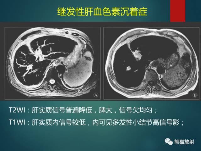 【PPT】肝糖原累积症(弥漫性肝实质密度增高病变的鉴别诊断)