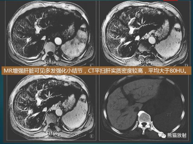 【PPT】肝糖原累积症(弥漫性肝实质密度增高病变的鉴别诊断)
