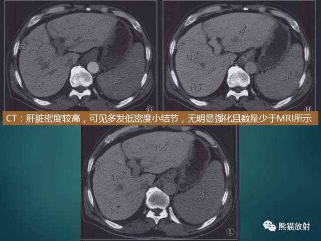 【PPT】肝糖原累积症(弥漫性肝实质密度增高病变的鉴别诊断)