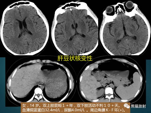【PPT】肝糖原累积症(弥漫性肝实质密度增高病变的鉴别诊断)