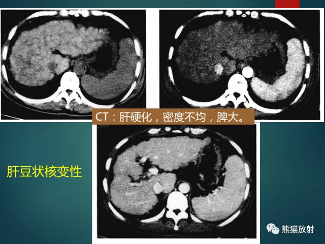 【PPT】肝糖原累积症(弥漫性肝实质密度增高病变的鉴别诊断)