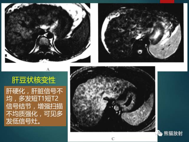 【PPT】肝糖原累积症(弥漫性肝实质密度增高病变的鉴别诊断)