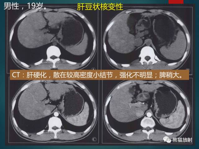 【PPT】肝糖原累积症(弥漫性肝实质密度增高病变的鉴别诊断)