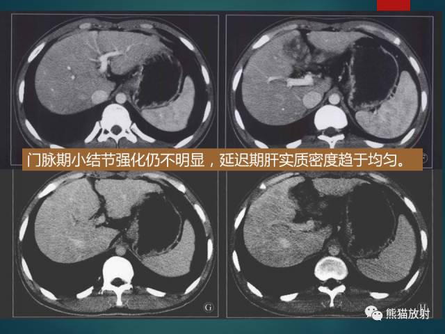 【PPT】肝糖原累积症(弥漫性肝实质密度增高病变的鉴别诊断)
