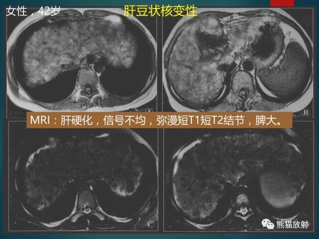 【PPT】肝糖原累积症(弥漫性肝实质密度增高病变的鉴别诊断)