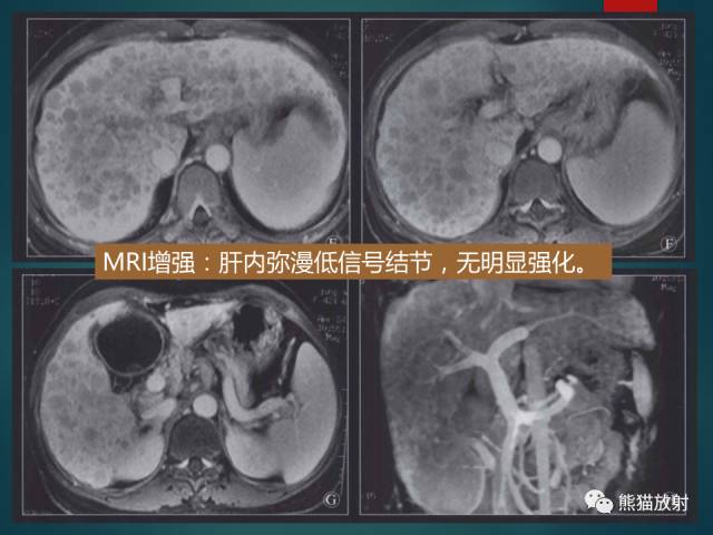【PPT】肝糖原累积症(弥漫性肝实质密度增高病变的鉴别诊断)