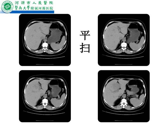 【病例】肝左叶内侧段高分化肝细胞性肝癌1例CT