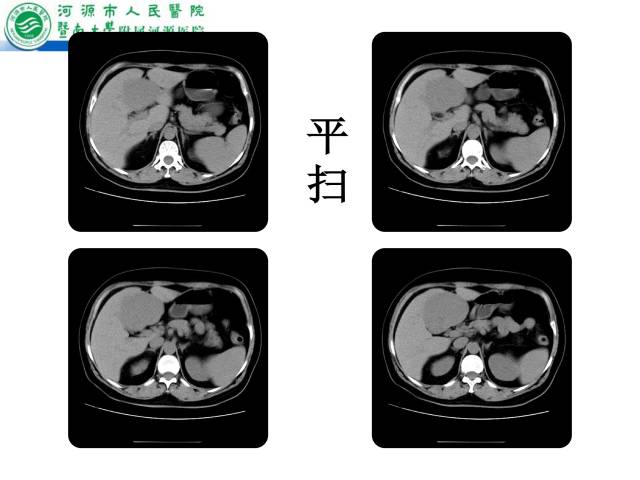 【病例】肝左叶内侧段高分化肝细胞性肝癌1例CT