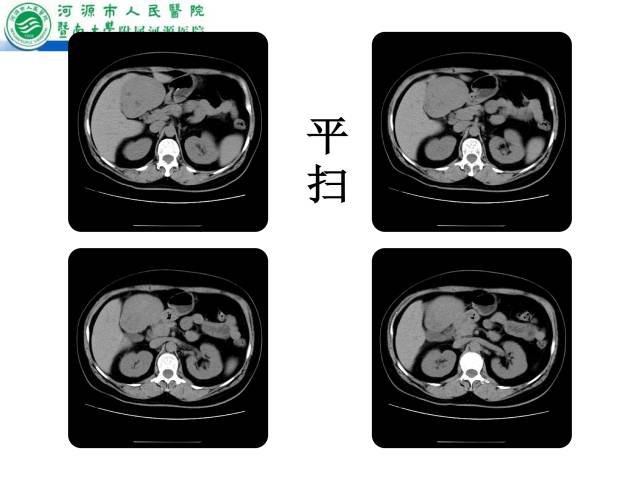 【病例】肝左叶内侧段高分化肝细胞性肝癌1例CT