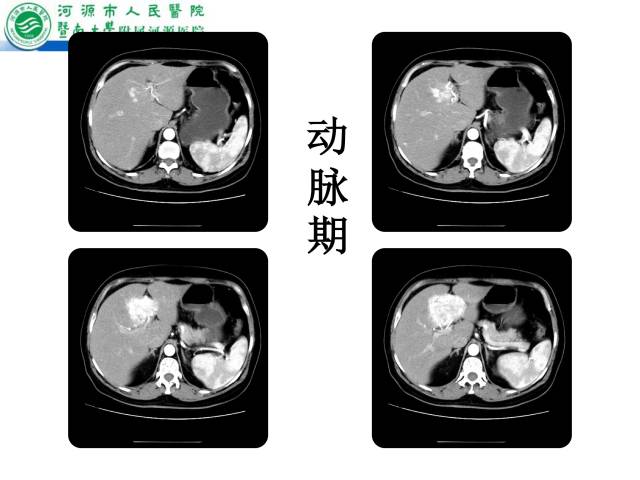 【病例】肝左叶内侧段高分化肝细胞性肝癌1例CT