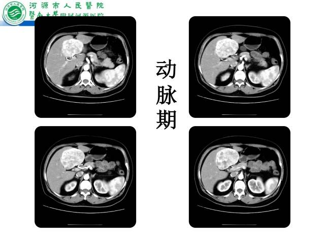 【病例】肝左叶内侧段高分化肝细胞性肝癌1例CT