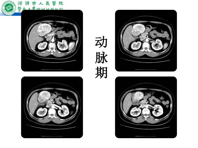 【病例】肝左叶内侧段高分化肝细胞性肝癌1例CT