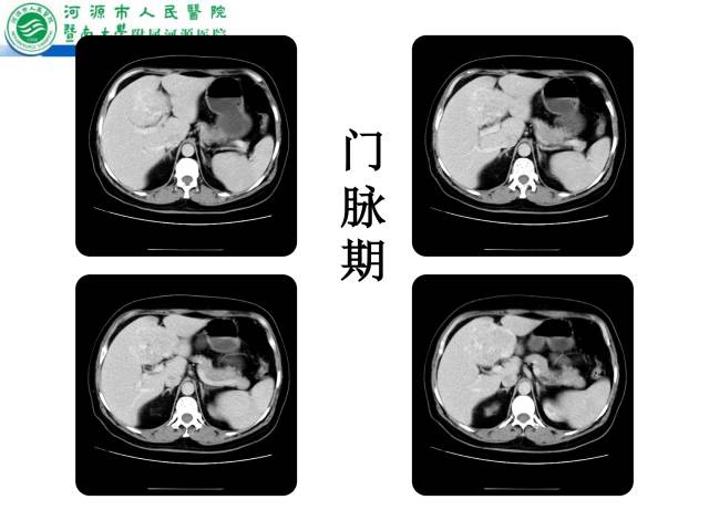 【病例】肝左叶内侧段高分化肝细胞性肝癌1例CT