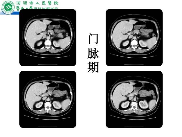 【病例】肝左叶内侧段高分化肝细胞性肝癌1例CT