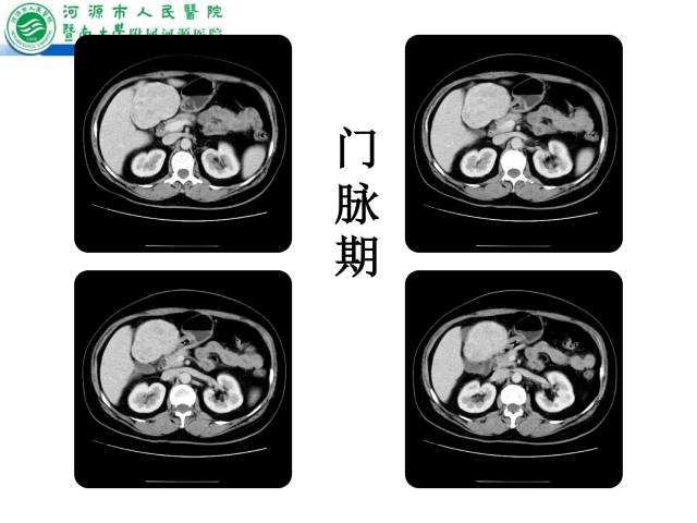 【病例】肝左叶内侧段高分化肝细胞性肝癌1例CT
