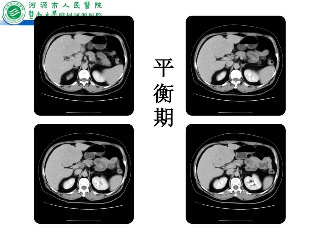 【病例】肝左叶内侧段高分化肝细胞性肝癌1例CT