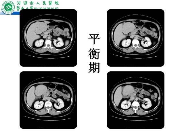 【病例】肝左叶内侧段高分化肝细胞性肝癌1例CT