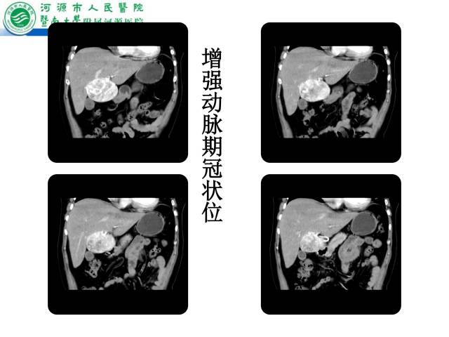【病例】肝左叶内侧段高分化肝细胞性肝癌1例CT