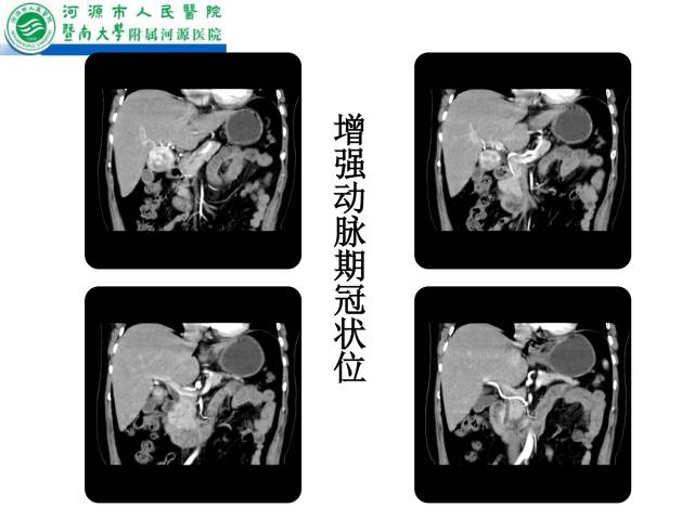 【病例】肝左叶内侧段高分化肝细胞性肝癌1例CT
