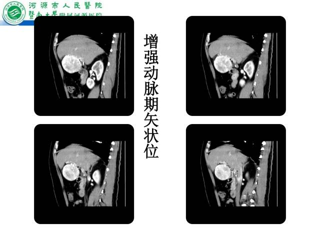 【病例】肝左叶内侧段高分化肝细胞性肝癌1例CT