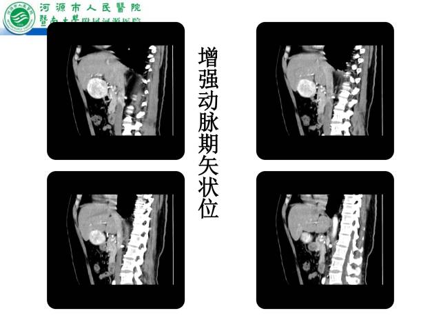 【病例】肝左叶内侧段高分化肝细胞性肝癌1例CT