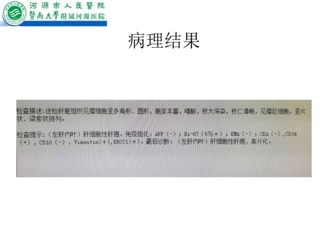 【病例】肝左叶内侧段高分化肝细胞性肝癌1例CT
