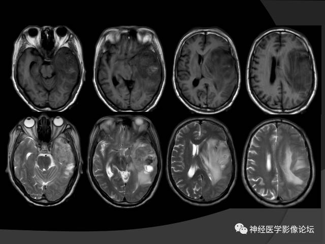【病例】左颞叶胶质肉瘤1例MR影像表现 【病例】左颞叶胶质肉瘤1例MR影像表现