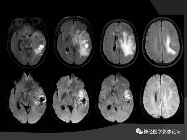 【病例】左颞叶胶质肉瘤1例MR影像表现 【病例】左颞叶胶质肉瘤1例MR影像表现
