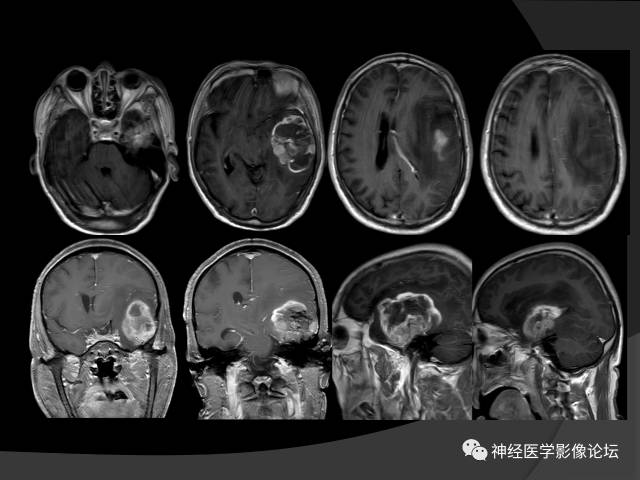 【病例】左颞叶胶质肉瘤1例MR影像表现 【病例】左颞叶胶质肉瘤1例MR影像表现