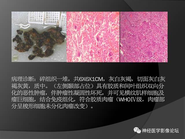 【病例】左颞叶胶质肉瘤1例MR影像表现 【病例】左颞叶胶质肉瘤1例MR影像表现