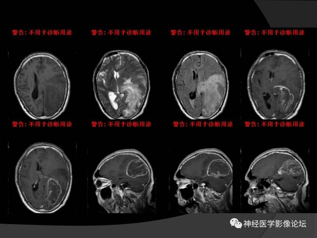 【病例】左颞叶胶质肉瘤1例MR影像表现 【病例】左颞叶胶质肉瘤1例MR影像表现