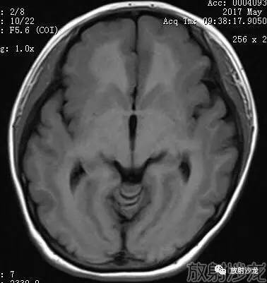 【病例】弥漫性带状灰质异位症1例MR