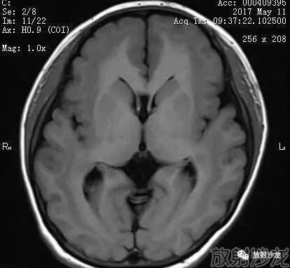 【病例】弥漫性带状灰质异位症1例MR