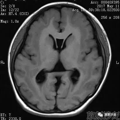 【病例】弥漫性带状灰质异位症1例MR