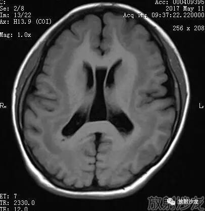 【病例】弥漫性带状灰质异位症1例MR