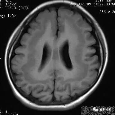 【病例】弥漫性带状灰质异位症1例MR