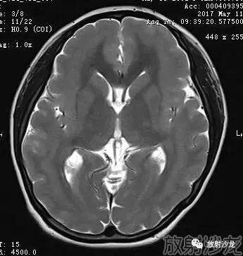 【病例】弥漫性带状灰质异位症1例MR