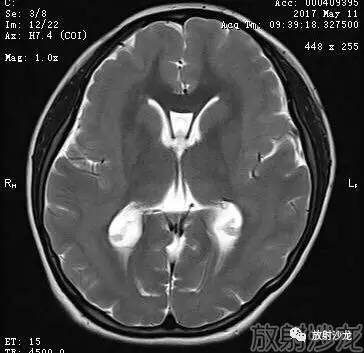 【病例】弥漫性带状灰质异位症1例MR