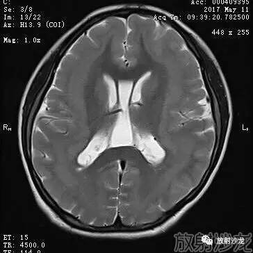 【病例】弥漫性带状灰质异位症1例MR