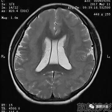 【病例】弥漫性带状灰质异位症1例MR